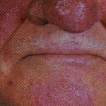 Rosacea (Akne rosacea)